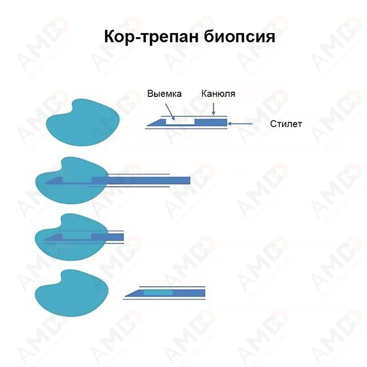 Игла_биопсийная_SuperCore_05_720_720 Игла_биопсийная_SuperCore_05_720_720
